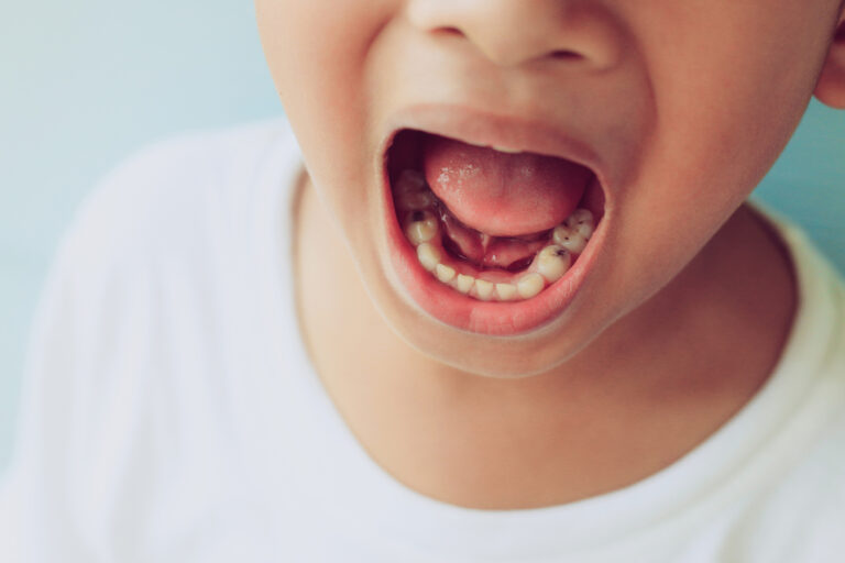 Child showing teeth with visible cavities, illustrating early signs of tooth decay for a dental health blog on prevention and detection.