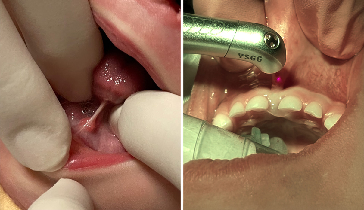 Frenectomy Procedure